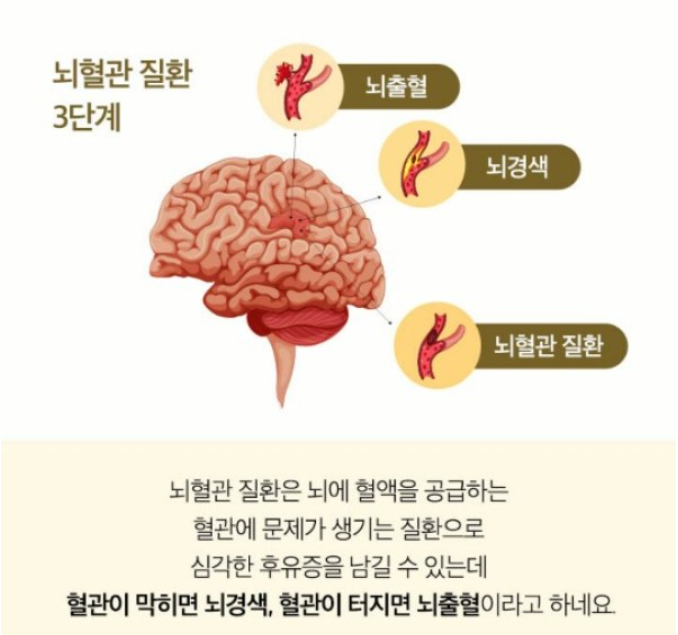 뇌혈관질환의 범위에 따라 다른 보장내역