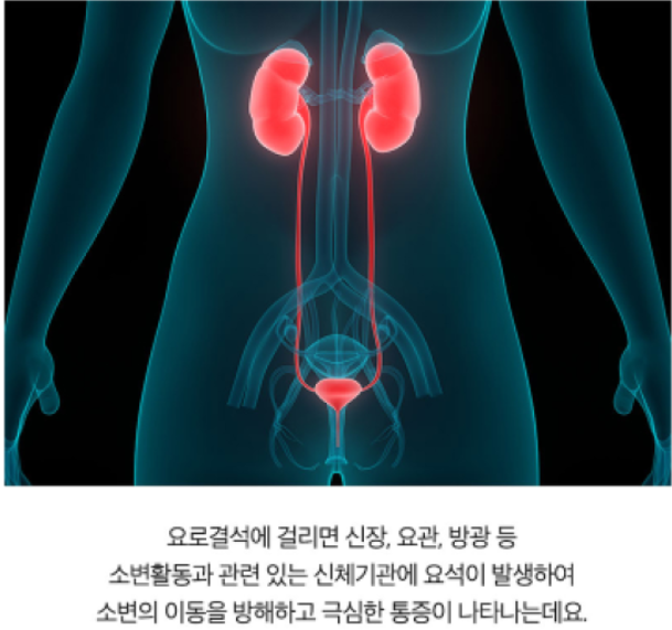 대표적인 비뇨기 질환의 하나인 요로결석! 방지하는 방법! 